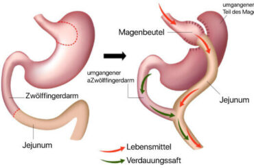 Endlich leichter leben! Endlich leichter leben Magenbypass türkei antalya magenoptuerkeicom