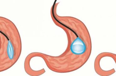 Leichtes Abnehmen mit dem Magenballon Die Magenballon-Behandlung ist in der Türkei eine erfolgreiche und sehr beliebte Methode. Weder eine Vollnarkose noch eine Operation werden notwendig. Der medizinische Eingriff erfolgt endoskopisch. Vergleichbar ist der Vorgang mit einer Magenspiegelung. Es erfolgt eine leichte Betäubung. Somit ist die körperliche Belastung sehr gering. Die Nebenwirkungen sind im niederschwelligen Bereich
