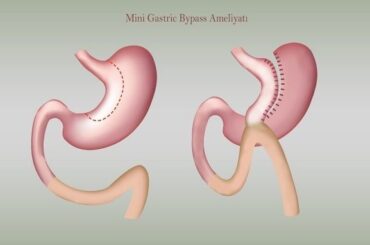 Die beliebte Mini-Magenbypass OP in der Türkei